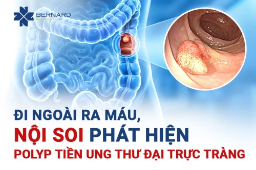 ĐI NGOÀI RA MÁU, NỘI SOI PHÁT HIỆN POLYP TIỀN UNG THƯ ĐẠI TRỰC TRÀNG